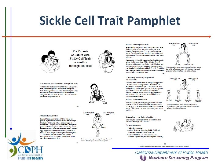 Sickle Cell Trait Pamphlet California Department of Public Health Newborn Screening Program 