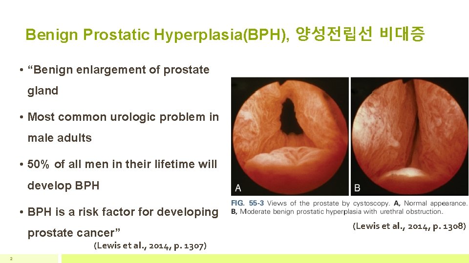 Benign Prostatic Hyperplasia(BPH), 양성전립선 비대증 • “Benign enlargement of prostate gland • Most common