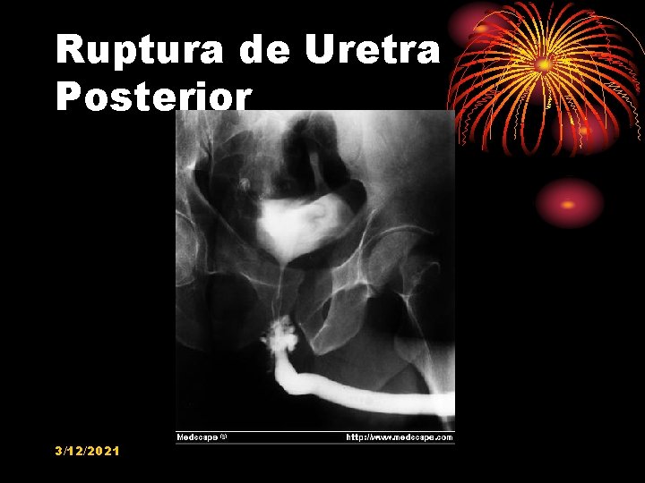 Ruptura de Uretra Posterior 3/12/2021 