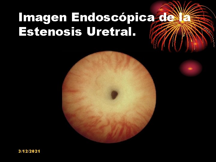 Imagen Endoscópica de la Estenosis Uretral. 3/12/2021 