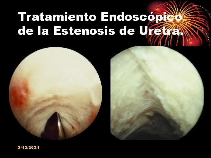 Tratamiento Endoscópico de la Estenosis de Uretra. 3/12/2021 