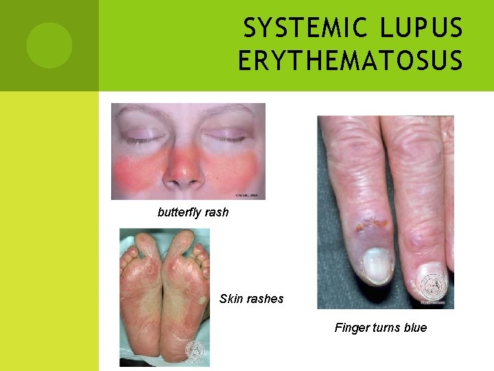 SYSTEMIC LUPUS ERYTHEMATOSUS butterfly rash Skin rashes Finger turns blue 