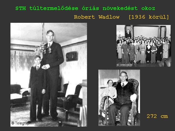 STH túltermelődése óriás növekedést okoz Robert Wadlow [1936 körül] 272 cm 