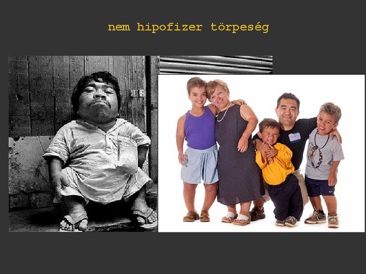 nem hipofizer törpeség 