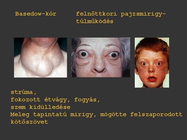 Basedow-kór felnőttkori pajzsmirigytúlműködés strúma, fokozott étvágy, fogyás, szem kidülledése Meleg tapintatú mirigy, mögötte felszaporodott