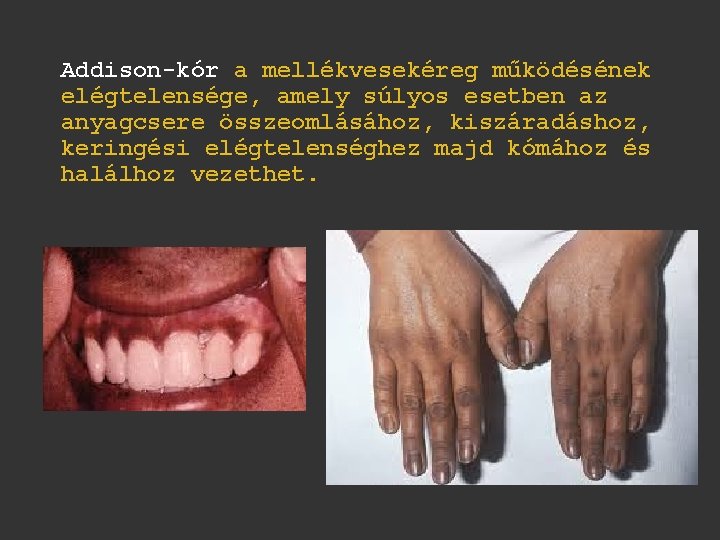 Addison-kór a mellékvesekéreg működésének elégtelensége, amely súlyos esetben az anyagcsere összeomlásához, kiszáradáshoz, keringési elégtelenséghez