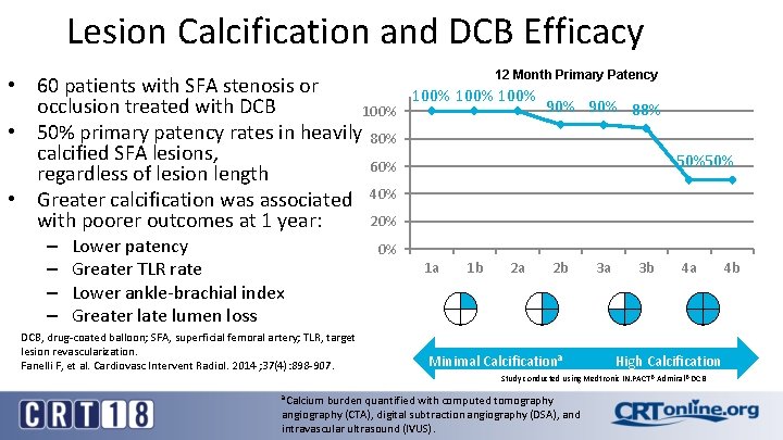 Lesion Calcification and DCB Efficacy • 60 patients with SFA stenosis or occlusion treated