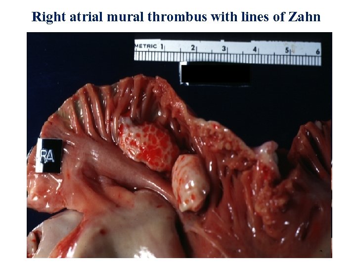 Right atrial mural thrombus with lines of Zahn 