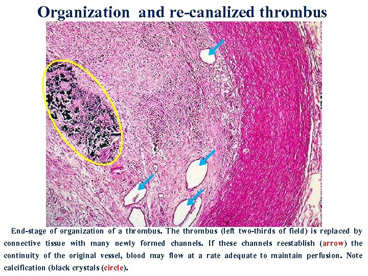 Organization and re-canalized thrombus End-stage of organization of a thrombus. The thrombus (left two-thirds