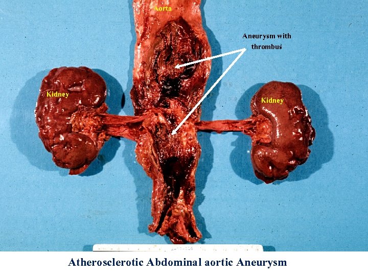 Aorta Aneurysm with thrombus Kidney Atherosclerotic Abdominal aortic Aneurysm 