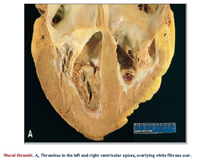 Mural thrombi. A, Thrombus in the left and right ventricular apices, overlying white fibrous