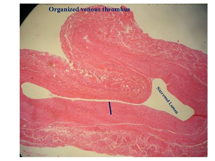 Organized venous thrombus en um d. L we rro Na 