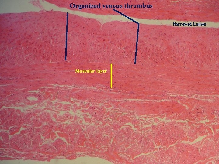Organized venous thrombus Narrowed Lumen Muscular layer 