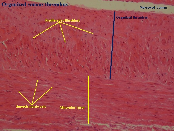 Organized venous thrombus Proliferative fibroblast Smooth muscle cells Muscular layer Narrowed Lumen Organized thrombus