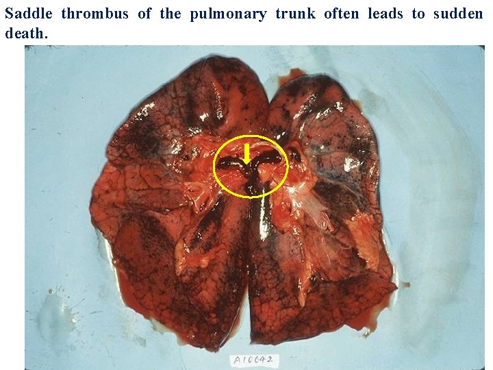 Saddle thrombus of the pulmonary trunk often leads to sudden death. 