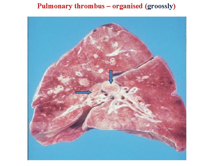Pulmonary thrombus – organised (groossly) 