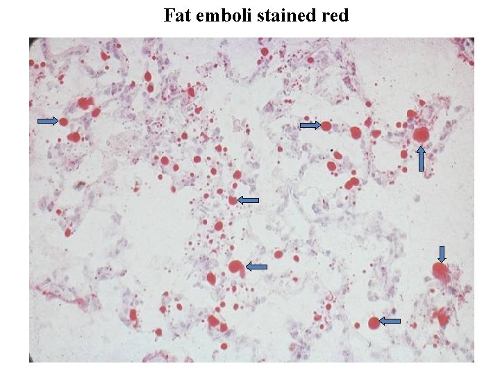 Fat emboli stained red 