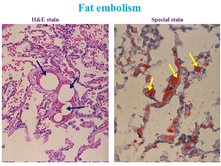 H&E stain Fat embolism Special stain 