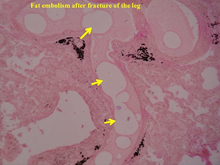 Fat embolism after fracture of the leg 