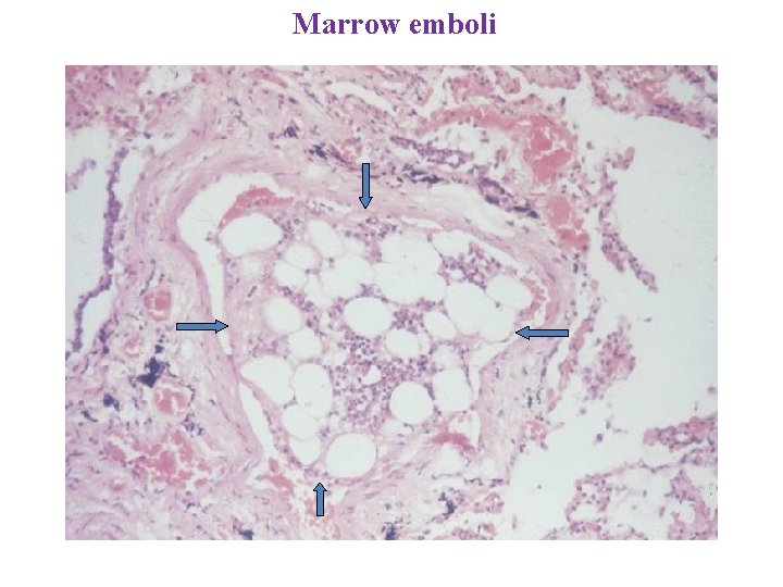 Marrow emboli 