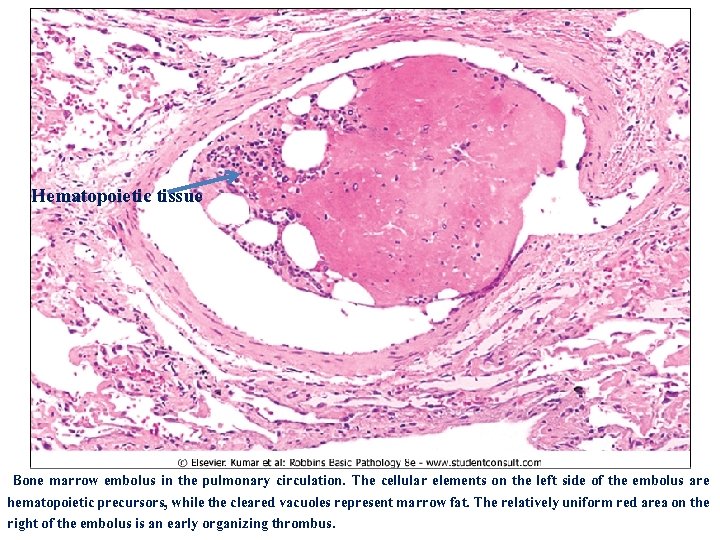 Hematopoietic tissue Bone marrow embolus in the pulmonary circulation. The cellular elements on the