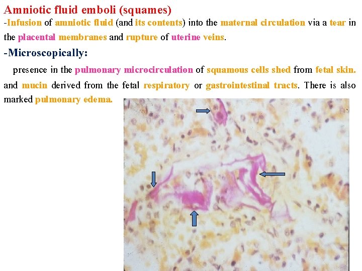 Amniotic fluid emboli (squames) -Infusion of amniotic fluid (and its contents) into the maternal