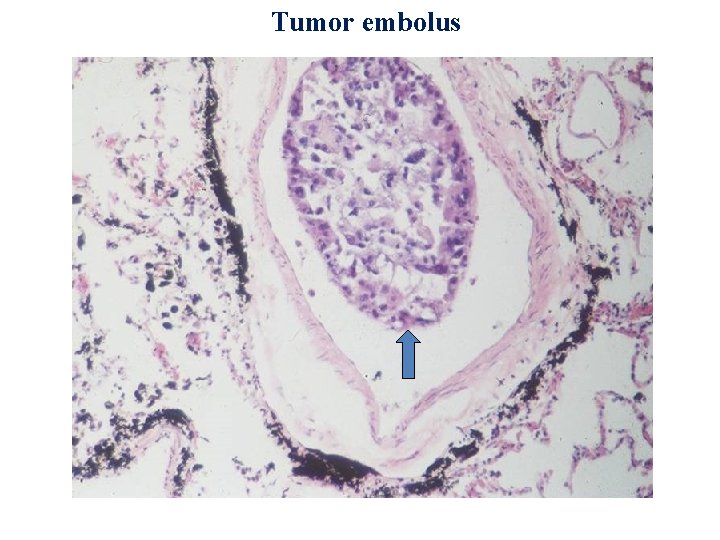 Tumor embolus 