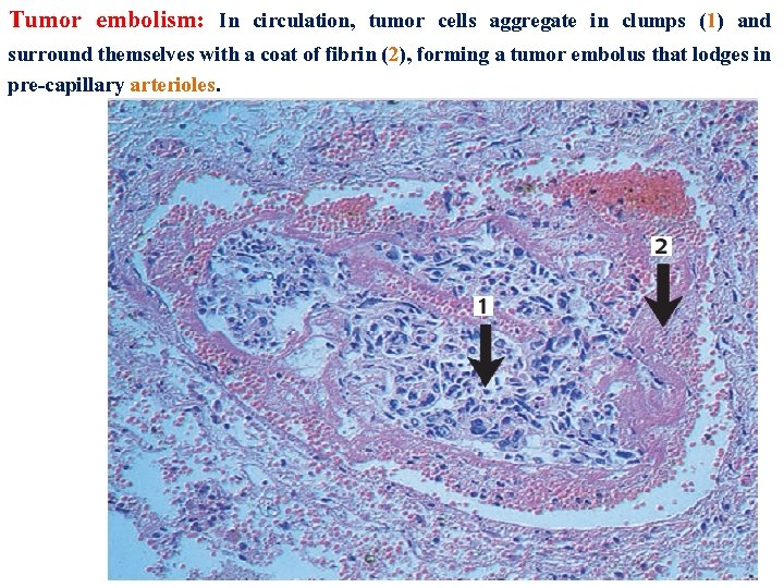 Tumor embolism: In circulation, tumor cells aggregate in clumps (1) and surround themselves with