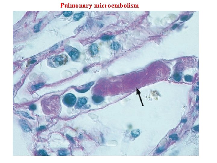 Pulmonary microembolism 