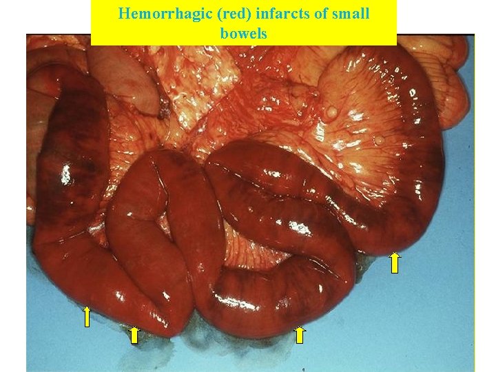 Hemorrhagic (red) infarcts of small bowels 