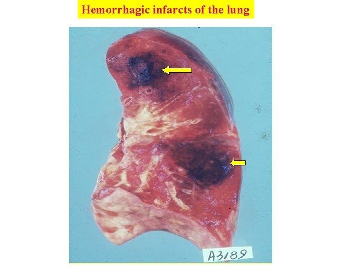 Hemorrhagic infarcts of the lung 