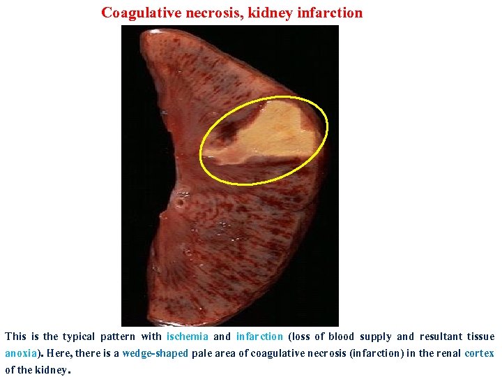 Coagulative necrosis, kidney infarction This is the typical pattern with ischemia and infarction (loss
