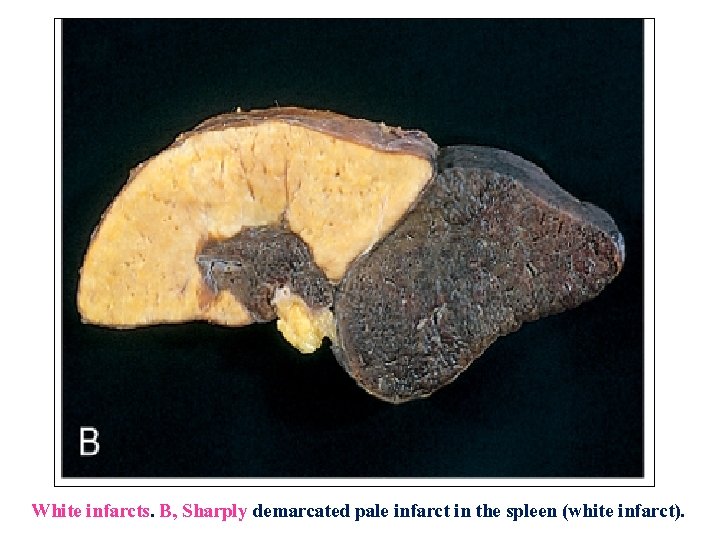 White infarcts. B, Sharply demarcated pale infarct in the spleen (white infarct). 