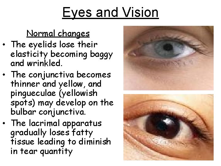 Eyes and Vision Normal changes • The eyelids lose their elasticity becoming baggy and