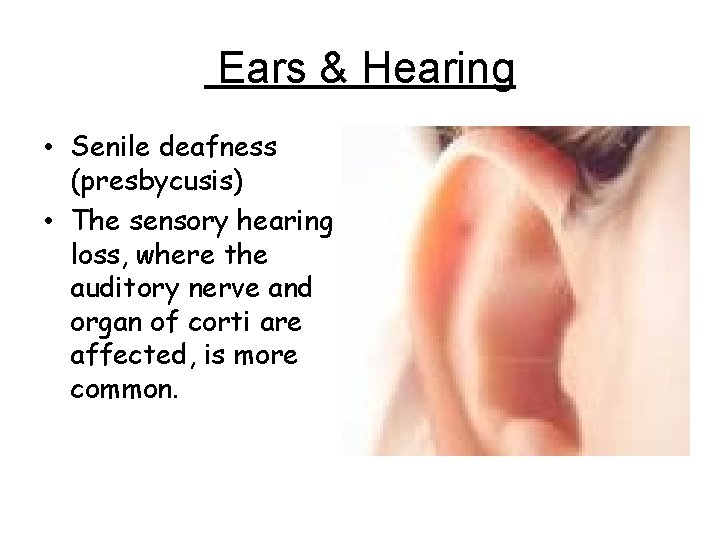 Ears & Hearing • Senile deafness (presbycusis) • The sensory hearing loss, where the