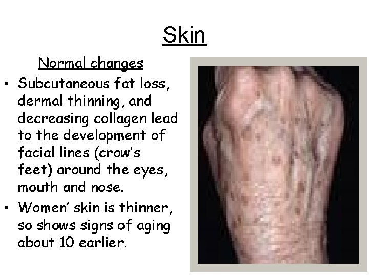 Skin Normal changes • Subcutaneous fat loss, dermal thinning, and decreasing collagen lead to