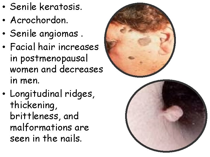 Senile keratosis. Acrochordon. Senile angiomas. Facial hair increases in postmenopausal women and decreases in