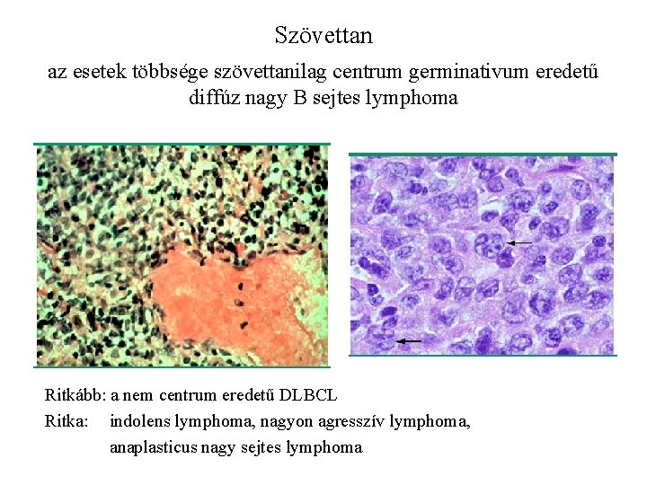 Szövettan az esetek többsége szövettanilag centrum germinativum eredetű diffúz nagy B sejtes lymphoma Ritkább: