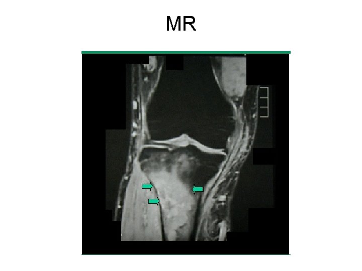 MR 