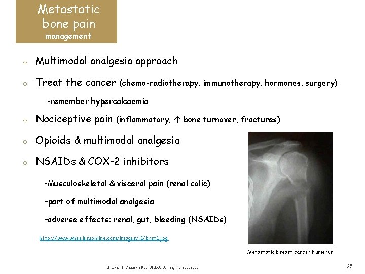 Metastatic bone pain management o Multimodal analgesia approach o Treat the cancer (chemo-radiotherapy, immunotherapy,