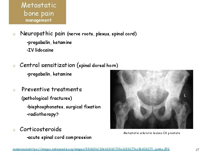Metastatic bone pain management o Neuropathic pain (nerve roots, plexus, spinal cord) -pregabalin, ketamine