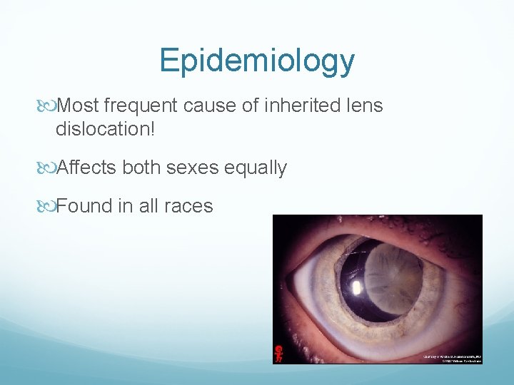 Epidemiology Most frequent cause of inherited lens dislocation! Affects both sexes equally Found in