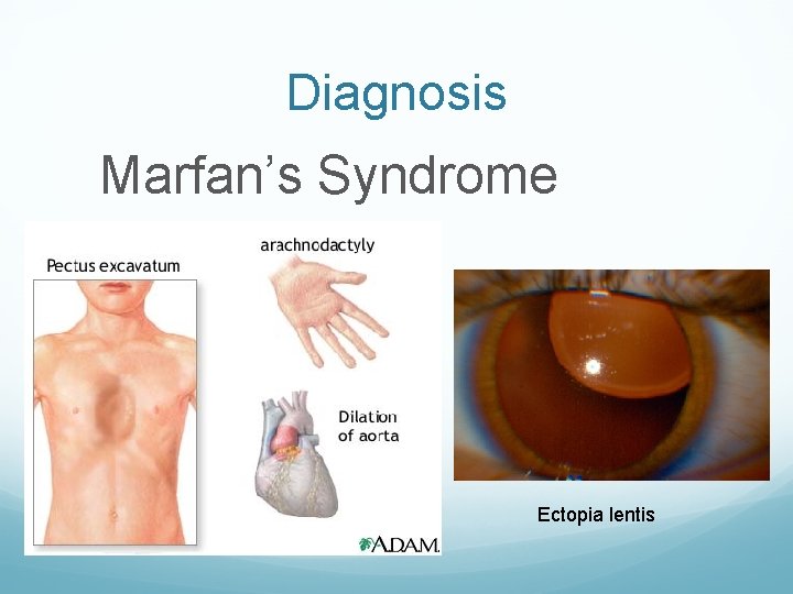 Diagnosis Marfan’s Syndrome Ectopia lentis 