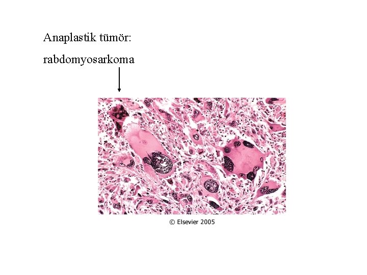 Anaplastik tümör: rabdomyosarkoma 