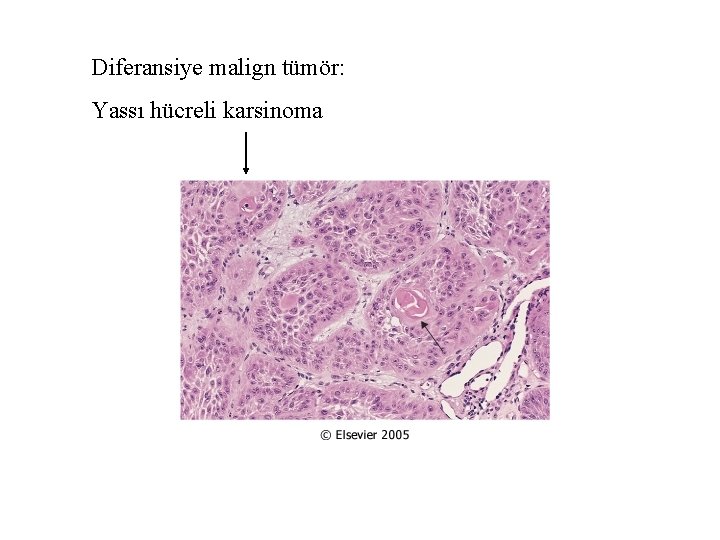 Diferansiye malign tümör: Yassı hücreli karsinoma 