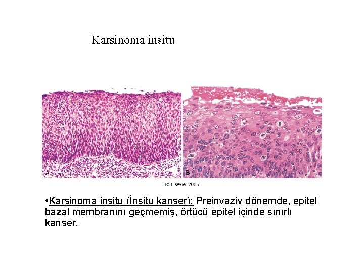 Karsinoma insitu • Karsinoma insitu (İnsitu kanser): Preinvaziv dönemde, epitel bazal membranını geçmemiş, örtücü