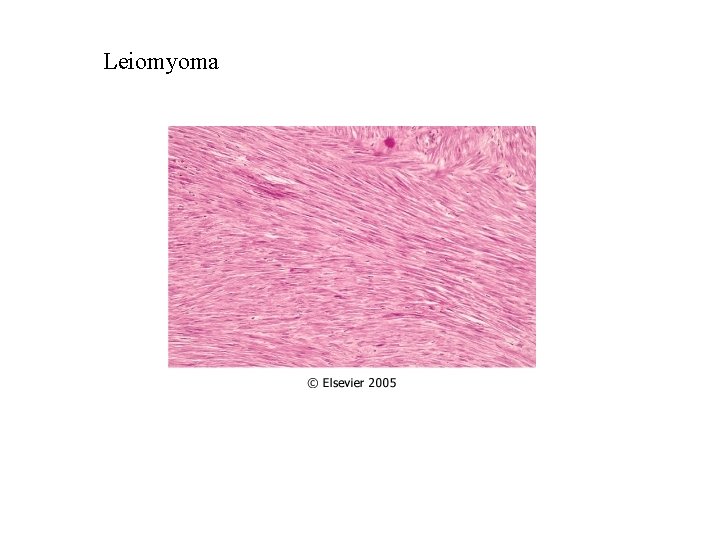 Leiomyoma 