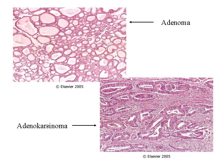 Adenoma Adenokarsinoma 