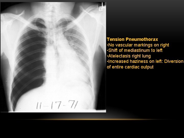 Tension Pneumothorax • No vascular markings on right • Shift of mediastinum to left