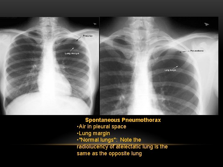 Spontaneous Pneumothorax • Air in pleural space • Lung margin • "Normal lungs": Note